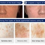 ai-driven-classification-system-revolutionizes-diagnosis-of-facial-pigmented-lesions