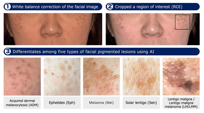 ai-driven-classification-system-revolutionizes-diagnosis-of-facial-pigmented-lesions