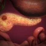 using-benzaldehyde-to-halt-the-spread-of-pancreatic-cancer