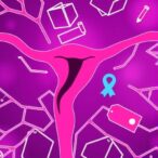 hrd-testing-advances-in-french-ovarian-cancer-study