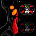 ml-enhances-spectral-ct-in-thyroid-nodule-diagnosis