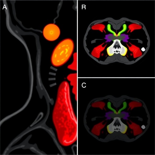 ml-enhances-spectral-ct-in-thyroid-nodule-diagnosis
