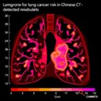 lung-cancer-risk-in-chinese-ct-detected-nodules