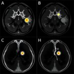 tumor-to-parenchyma-pet-ratio-predicts-chemotherapy-response