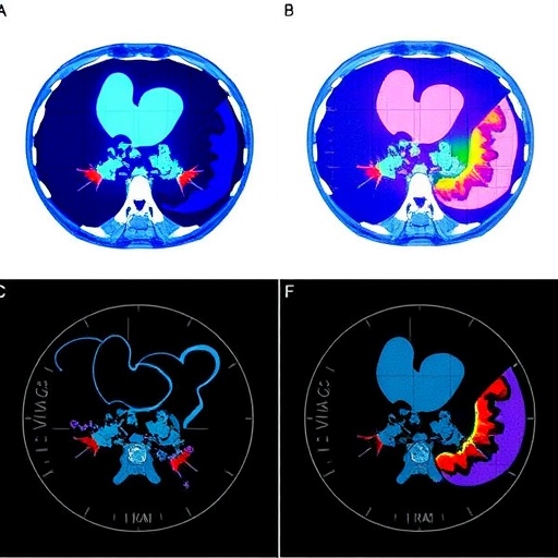 ct-radiomics-model-distinguishes-liver-tumors-pre-surgery