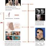 innovative-surgical-method-enables-safe-removal-of-giant-nerve-tumors