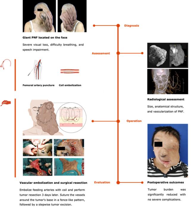 innovative-surgical-method-enables-safe-removal-of-giant-nerve-tumors