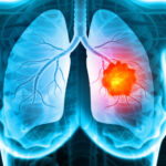 corticosteroids-reduce-effectiveness-of-immunotherapy-for-nsclc