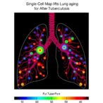 single-cell-map-unveils-lung-aging-after-tuberculosis