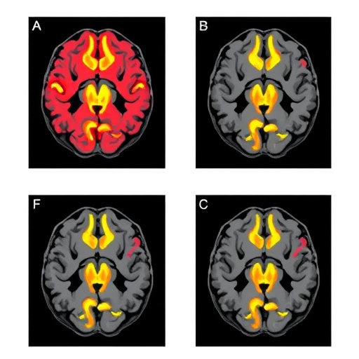 neonatal-brain-volume-predicts-executive-function-in-preterms