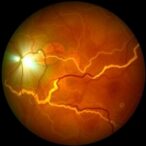 noninvasive-retinal-scan-detects-kidney-disease-types