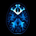 deep-learning-advances-mri-diagnosis-of-brucella