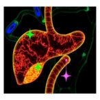mlh1-and-gprc5c:-prognostic-markers-in-liver-cancer