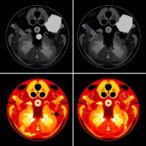 ai-predicts-sinus-surgery-outcomes-from-images