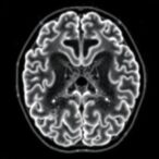 predicting-glioma-response-to-chemoradiation