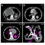 imaging-and-surgery-of-retroperitoneal-vascular-leiomyosarcoma
