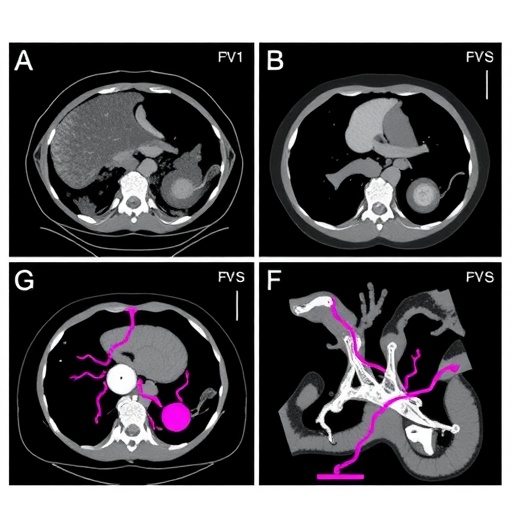 imaging-and-surgery-of-retroperitoneal-vascular-leiomyosarcoma