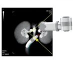 ultrasound-guided-robotic-percutaneous-nephrolithotomy-advances