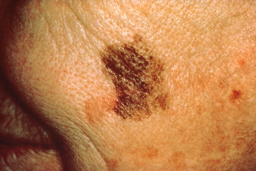 melanoma-cells-in-mice-steered-by-protein’s-unexpected-function