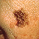 melanoma-cells-in-mice-steered-by-protein’s-unexpected-function