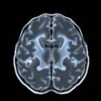 neuroimaging-reveals-cognitive-traits-in-moderate-preterms