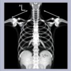 ct-scans:-raised-arms-improve-clavicle-age-estimates