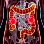 blastocystis-infection-linked-to-colorectal-cancer