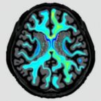 optimizing-inversion-time-in-postmortem-1.5t-flair-imaging