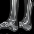 proximal-medial-tibial-bump:-a-normal-variant