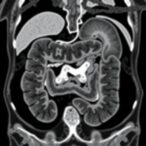 preoperative-mri-improves-stage-ii-iii-colon-cancer-outcomes