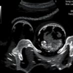 ultrasound-insights-on-hip-dysplasia-in-infants