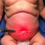 newborn-idiopathic-scrotal-hematoma:-case-study-insights