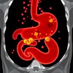 metastatic-gastric-cancer:-survival-varies-by-site