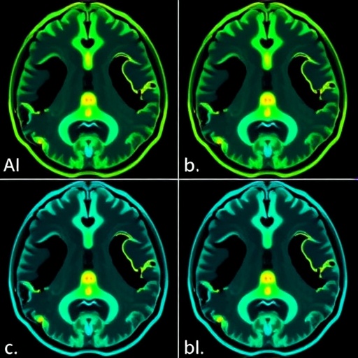 evaluating-observer-consistency-in-cerebellar-mutism-imaging