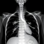 rare-case:-tracheal-bronchus-complicates-pulmonary-agenesis