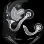 120-mmhg-limit:-key-to-safe-intussusception-reduction