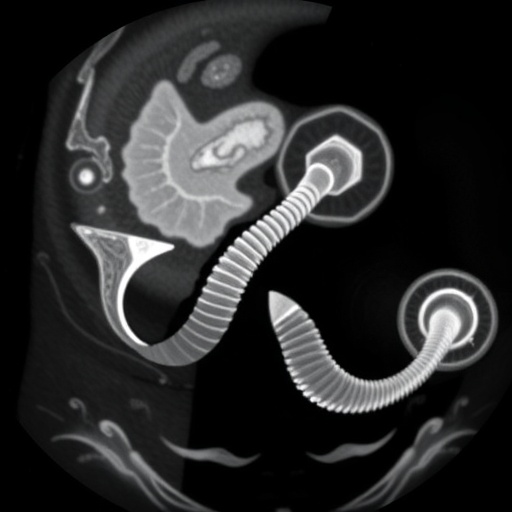 120-mmhg-limit:-key-to-safe-intussusception-reduction