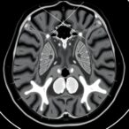 enhancing-pediatric-abdominal-mri-quality-with-deep-learning