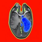 deepisles:-clinically-validated-stroke-segmentation-model