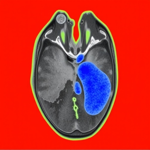 deepisles:-clinically-validated-stroke-segmentation-model