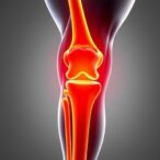 minimally-invasive-procedure-eases-painful-symptoms-of-knee-osteoarthritis