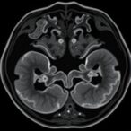 exploring-fetal-mri-insights-in-conjoined-twins