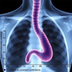 4-year-results:-tislelizumab-plus-chemo-for-esophageal-cancer