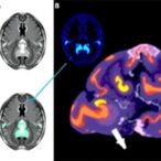 ai-advances-transform-neuroprognosis-in-neonatal-encephalopathy