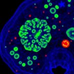 new-fluorescent-imaging-method-enables-rapid-and-safe-detection-of-basal-cell-carcinoma