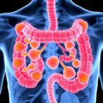 lymph-node-subtypes-reveal-colorectal-cancer-insights