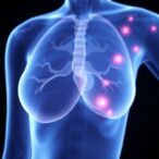 new-insights-on-preventing-breast-cancer-lymphedema