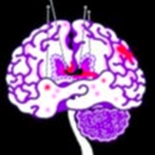 rbms1:-immune-infiltration’s-role-in-glioma-prognosis