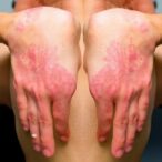 switching-ct-p17-and-adalimumab-in-psoriasis-study