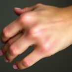 diabetes-worsens-outlook-in-psoriasis,-coronary-artery-disease